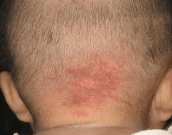 2)毛细血管痣(或叫鲜红斑痣):出生时即有或出生后不久发生,好发面