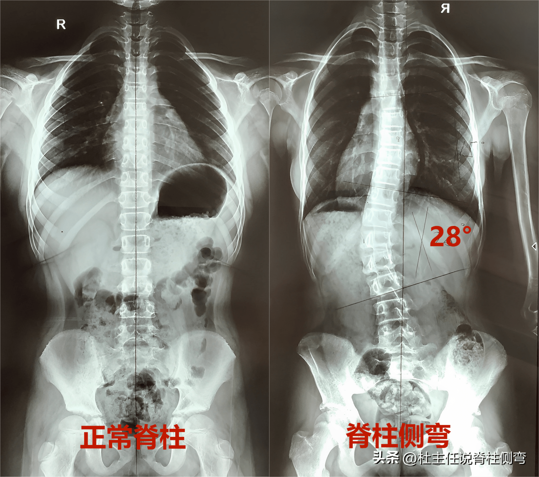 如果x光片显示脊柱cobb角度有大于10度的侧方弯曲,即可诊断为脊柱侧弯