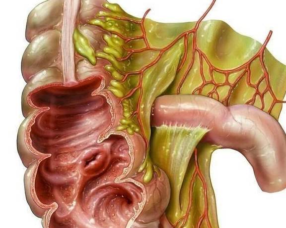 阑尾炎消炎后,如果再复发的话情况会是怎样?_治疗_手术_局部