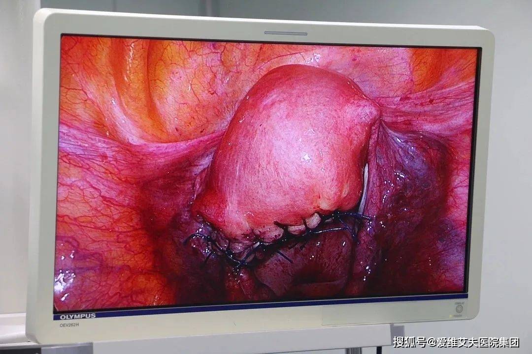 祛"瘤"留"宫",手术直击:钟美华团队摘除作恶多年子宫肌瘤_腹腔镜_进行