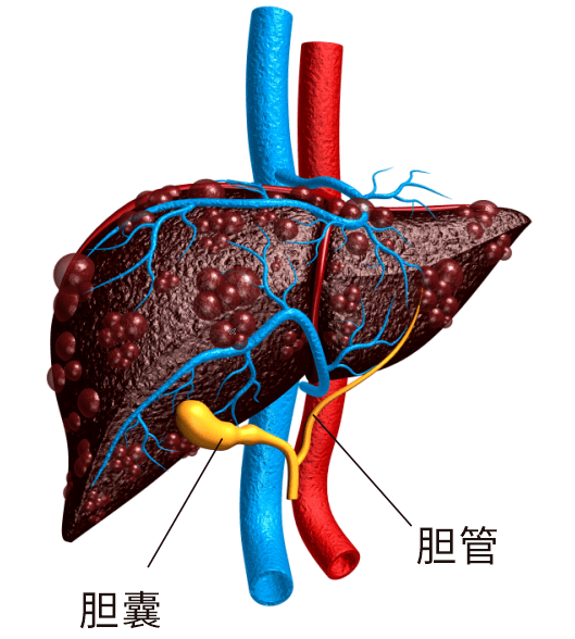 胆道恶性肿瘤主要包括胆囊癌和胆管癌