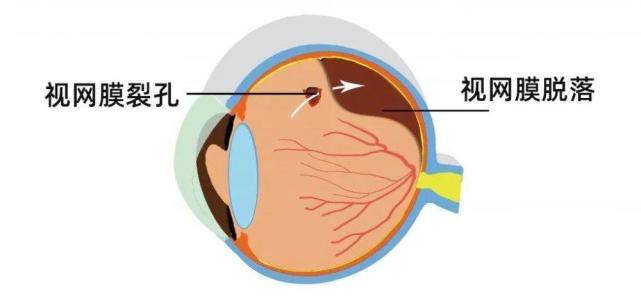视网膜在哪个位置图片图片