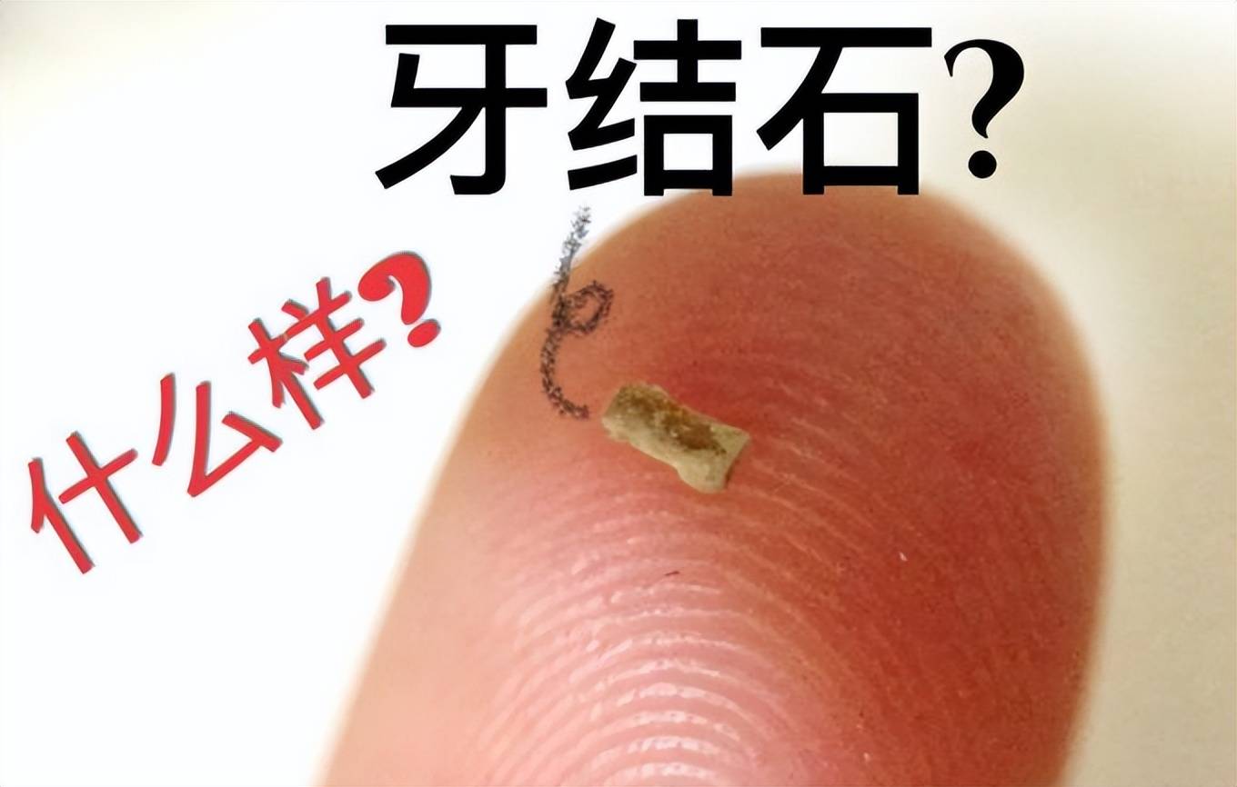 过来人分享三步,顽固牙石大块全掉!_牙齿_牙粉_时间