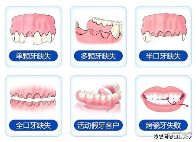 种植牙能使用多久什么材料（种植牙能使用多久？）