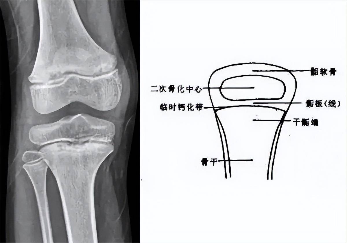 专管骨骼生长的骺软骨,它与干骺端之间有一盘状软骨结构称为骺板(线)