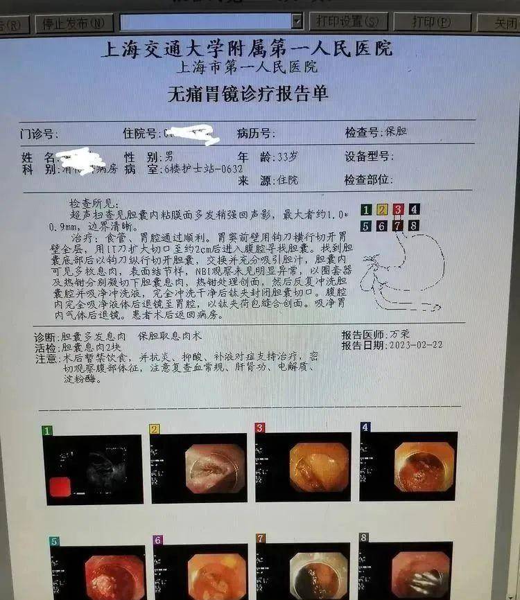 无痛胃镜诊疗报告单超声内镜探查胆囊内多发略高回声,考虑多发息肉,最