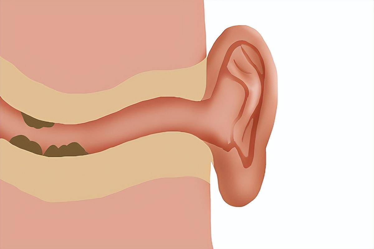 因为在我国大多数的人群都是干性耵聍,所以少部分油性耵聍的人群就会