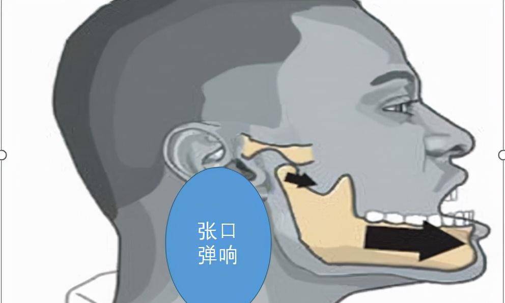 张嘴时听到“咔哒”响？医生直言：这是一种病，5招教你改善_下颌_关节_运动