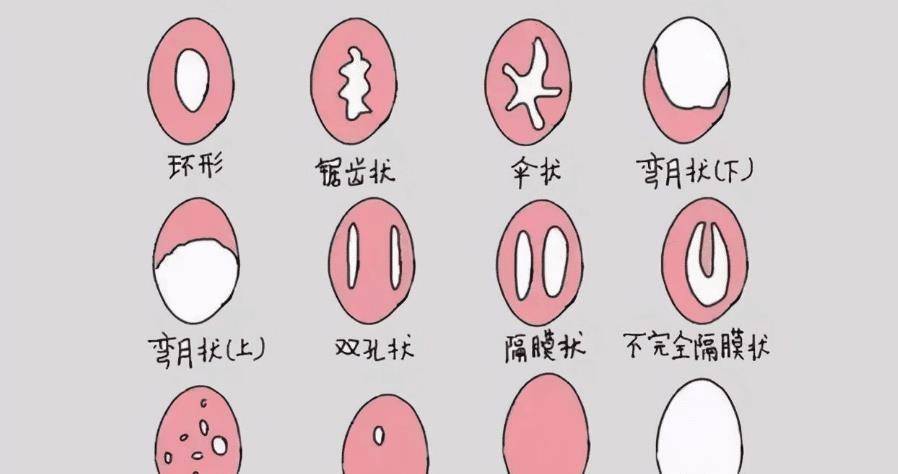 什么是"阴式"b超?检查需要哪些步骤?