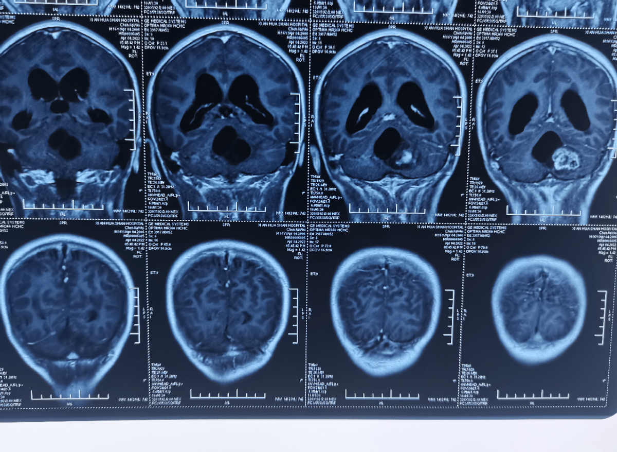 脑瘤核磁共振图片图片