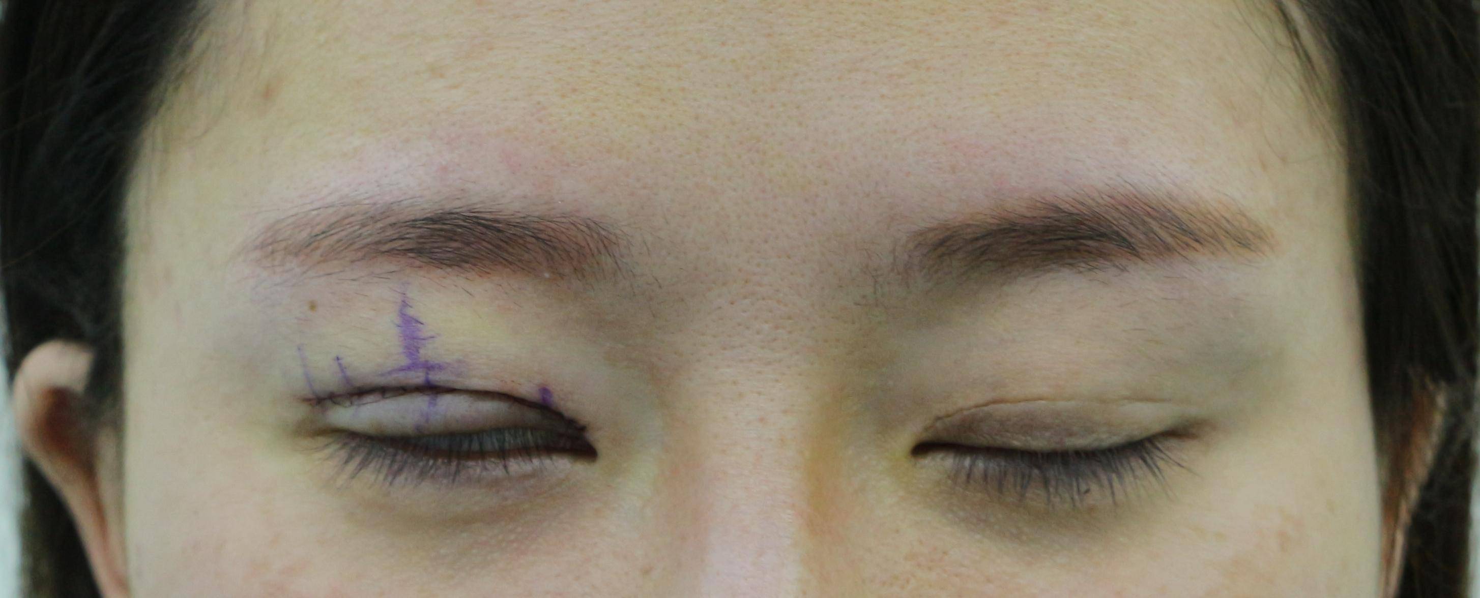 江苏姑娘第3次修复上睑下垂,术后7天双眼对称有神,双眼皮也自然_右眼