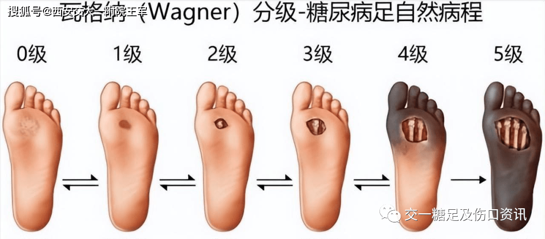 糖尿病足分级以及图片图片