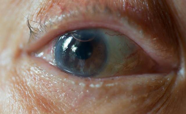 白内障并不只是老年人的标签,年轻人更要注意!_时期_眼睛_眼球