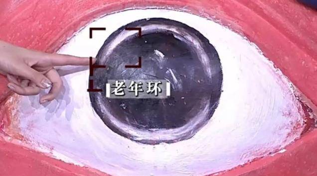 眼球边缘如果出现一圈灰白色的,宽约1～2毫米的环状结构,这就是老年环