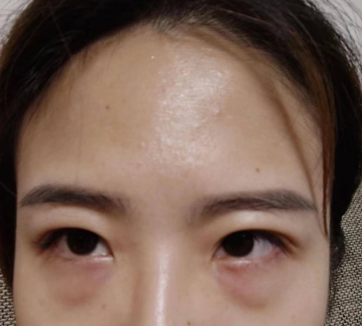 上睑臃肿,下睑眼袋突出,眶隔脂肪堆积,皮肤无松弛情况,但整个眼部有一