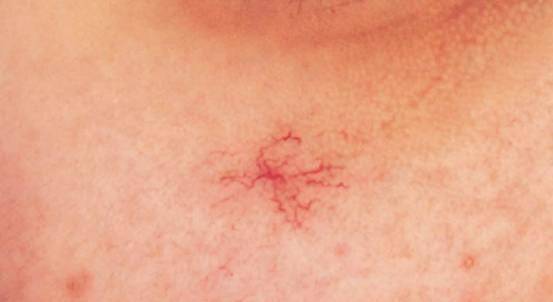 肝硬化患者在早期的时候,常能见到的就是蜘蛛痣长在身材口或者背部上