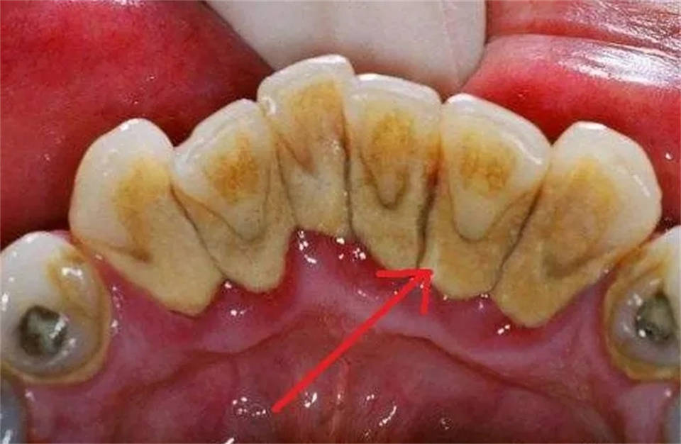 牙结石反复滋生口气难闻怎么办?跟着我做,在家也能除牙石清口气!