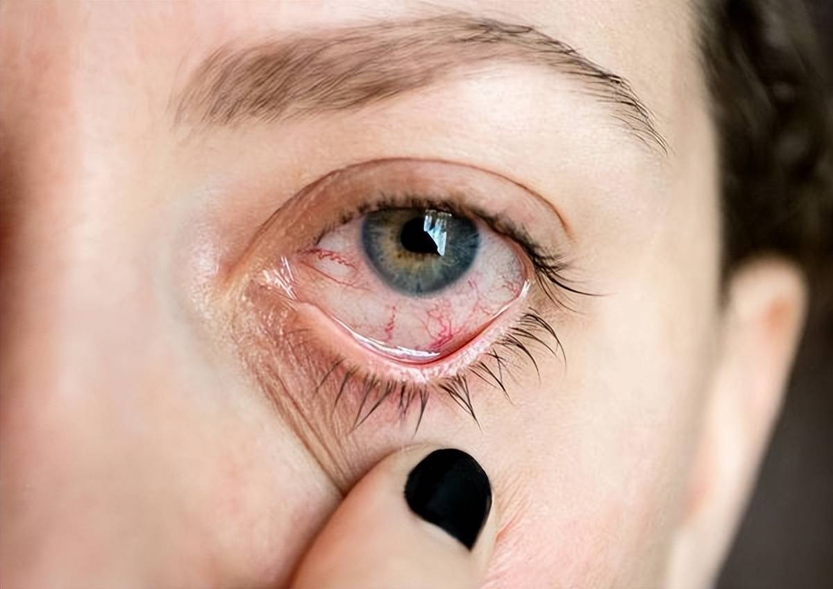 什么原因可以导致青光眼 青光眼的症状和表现是什么