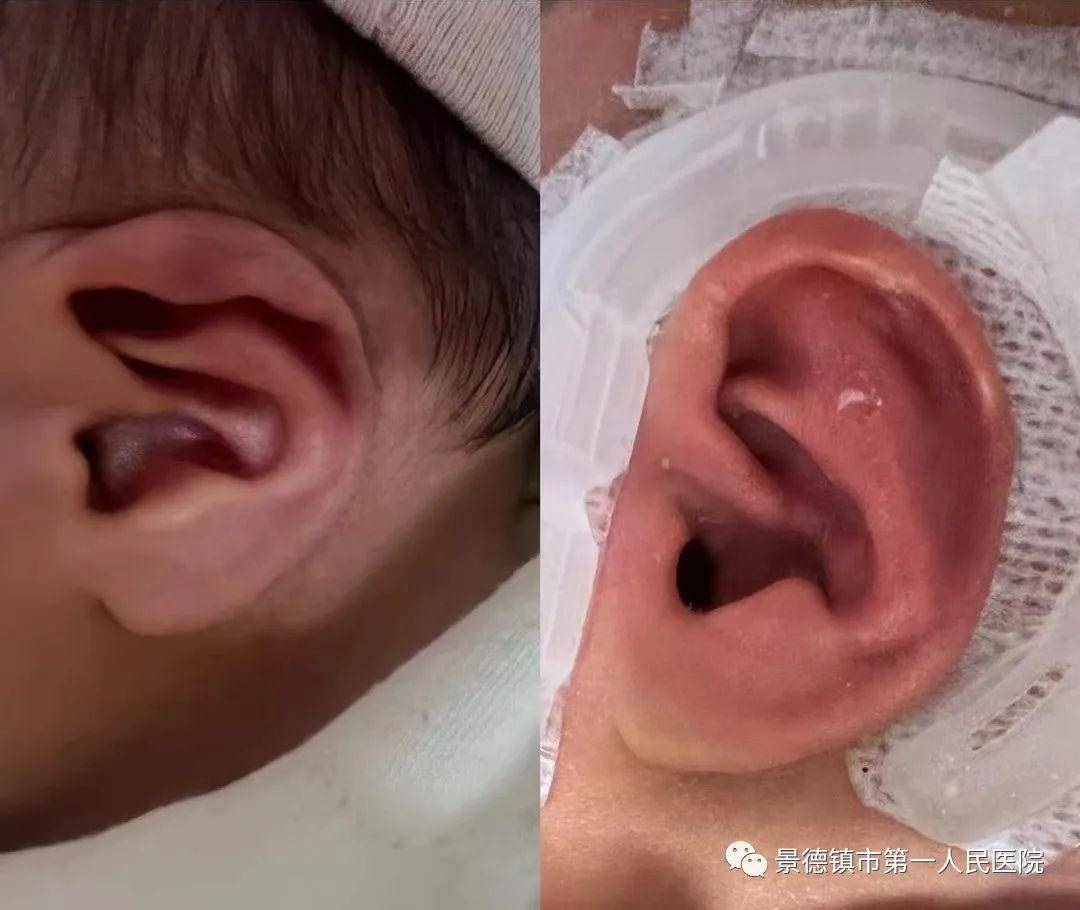 据仇晓露介绍,有些孩子在出生后,可能就会出现耳朵形状不一致的情况