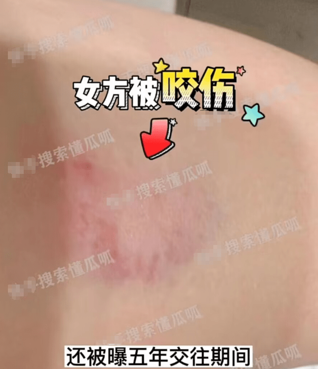 癖好,情侣间发生关系时遭到蒙恩虐待咬伤手臂,伤口处可见明显牙齿印