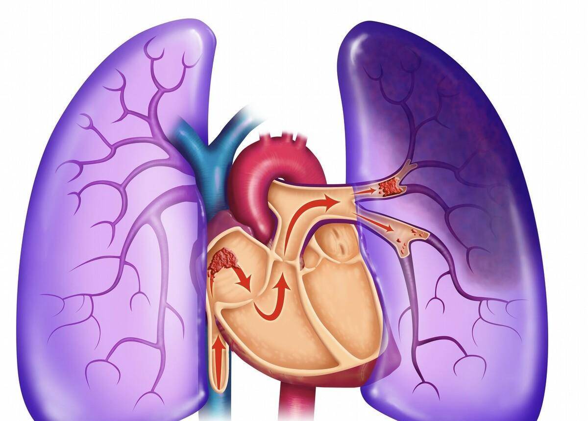 空气栓塞心脏图片图片