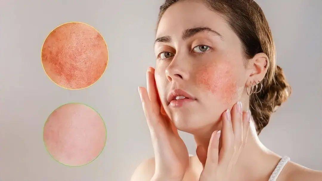 呵护好敏感肌,把你的脸红留给心动!_皮肤_产品_补水