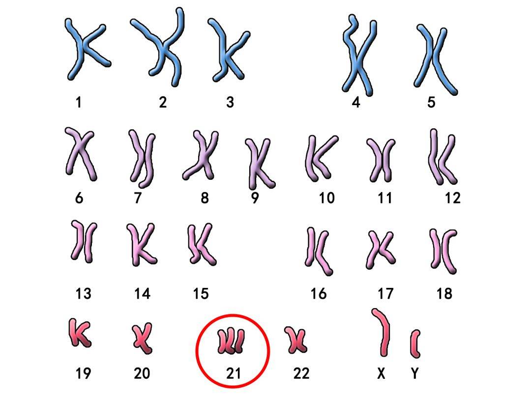 21三体综合征 染色体图片