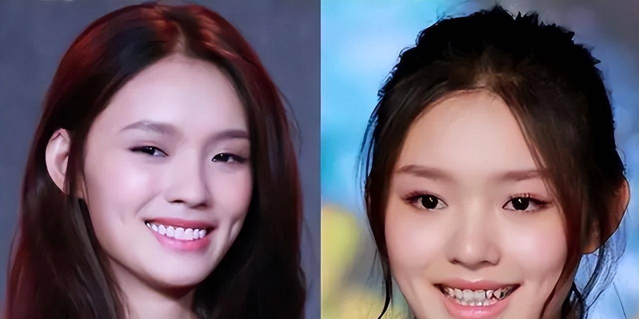明星"烤瓷牙"有多可怕?