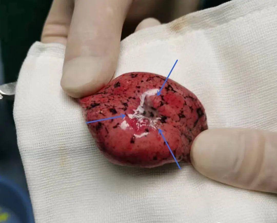 病例分享:又一例,这招判断这一类肺结节性质屡试不爽!