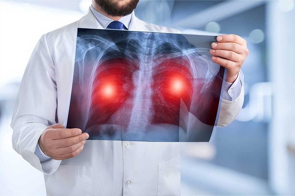 引发肺癌的因素有哪些 哪些因素容易导致肺癌的出现
