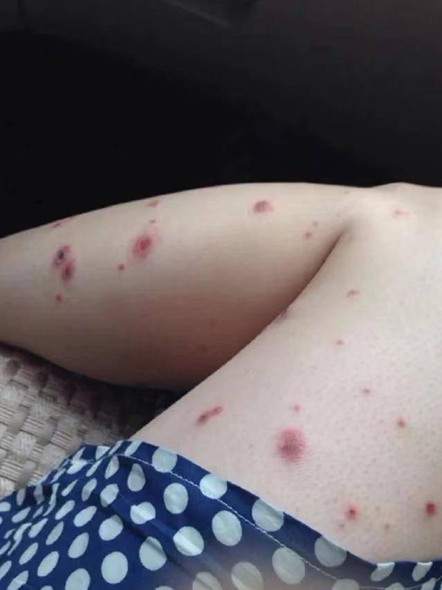 湿疹遍布全身瘙痒难忍?过来人自用指南分享,学会马上不痒了!