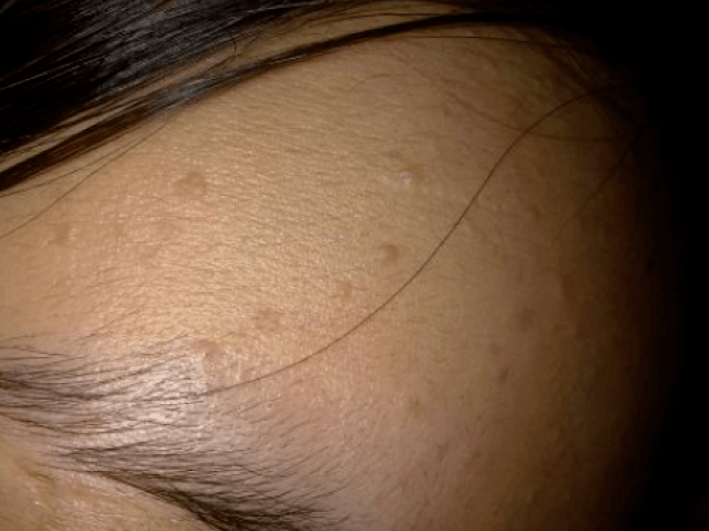 口碑科普:治疗扁平疣要注意以下几个误区_患者_免疫_患处