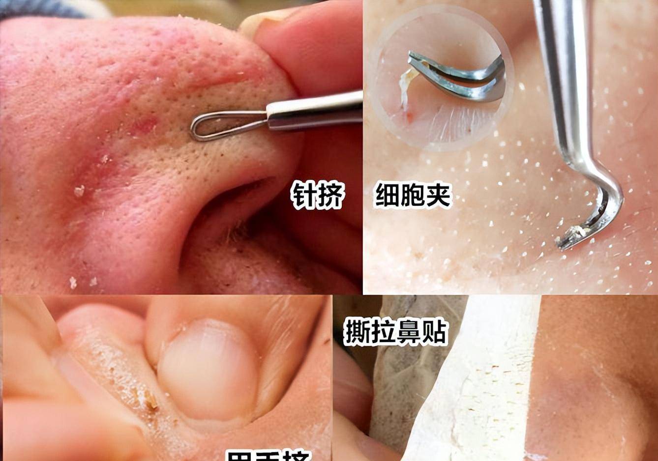 鼻子上挤的白条条的东西是脂质微丝吗?_黑头_毛孔_油脂