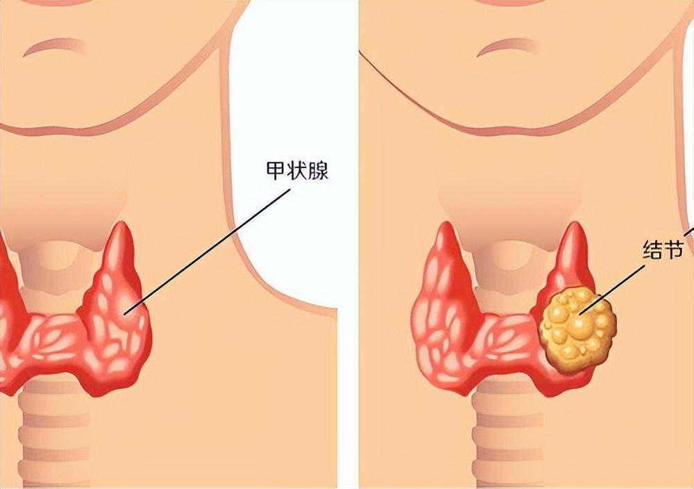 甲状腺正常图片大全图片