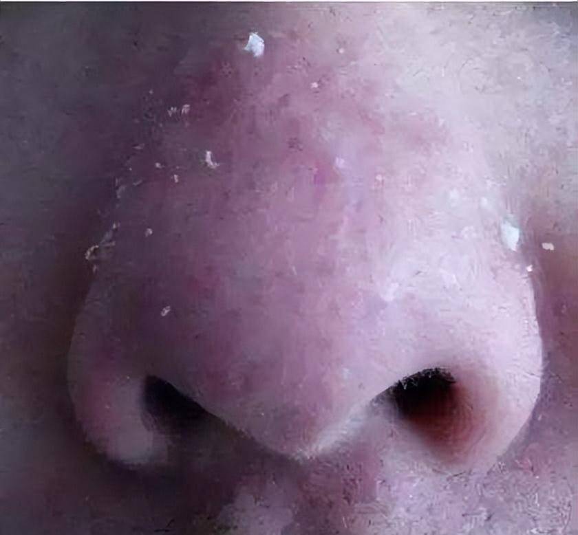 "脂质微丝"到底是什么?鼻子上挤的白条条的东西是脂质微丝吗?