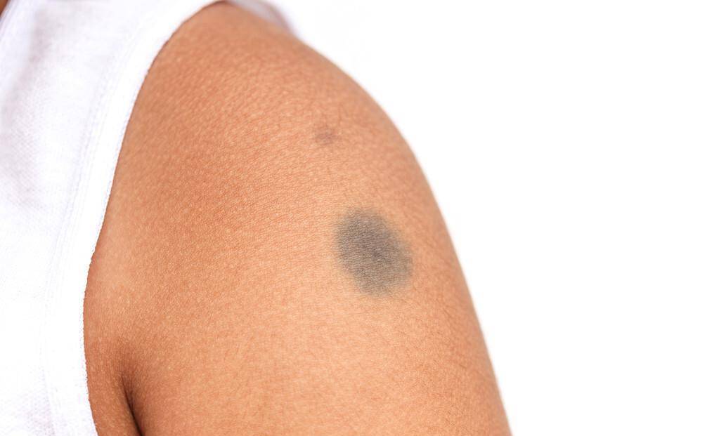 错把艾滋病当成皮肤病!皮肤出现3种情况,可能是艾滋发出的信号