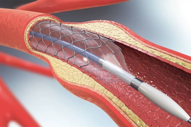 心脏支架图片国产图片