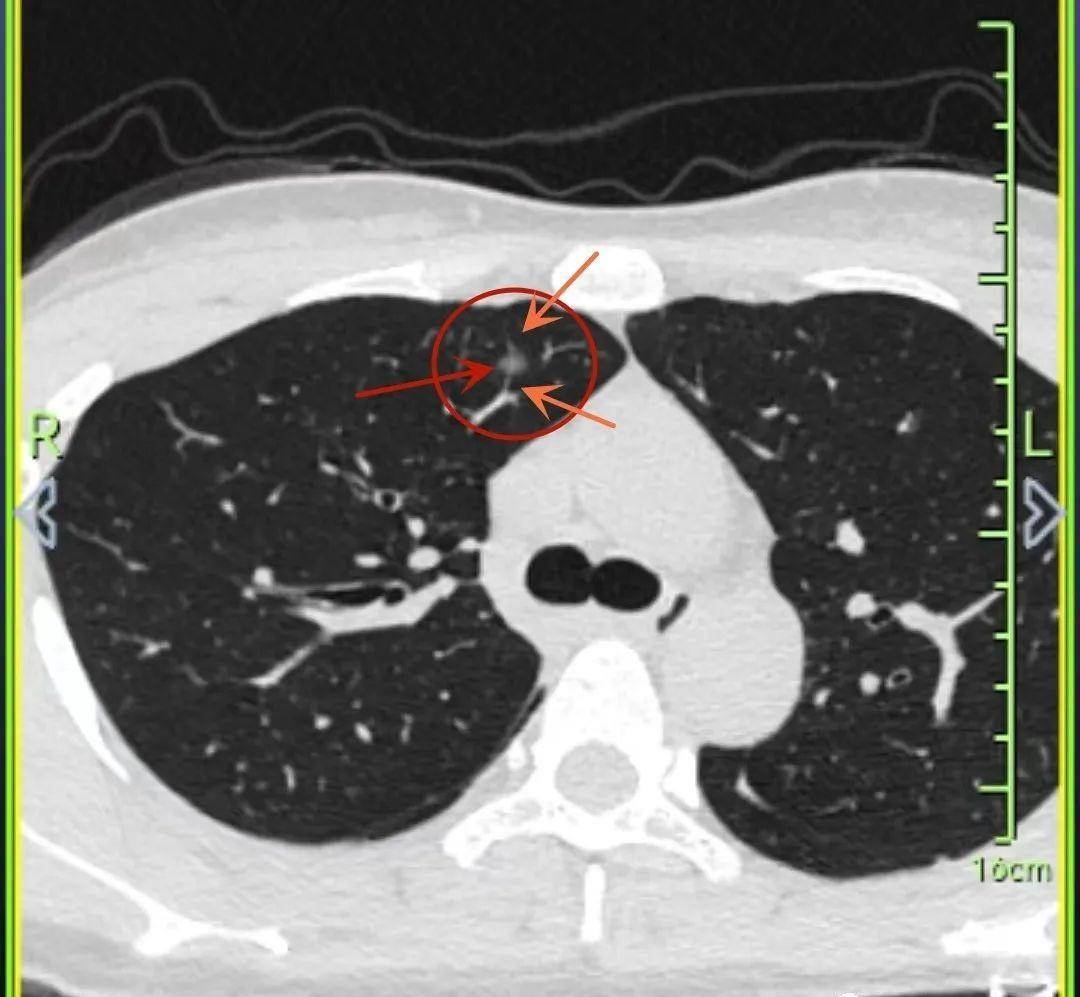 33岁女性磨玻璃结节2年伴空泡征血管征,但只有6毫米,要不要手术_原位