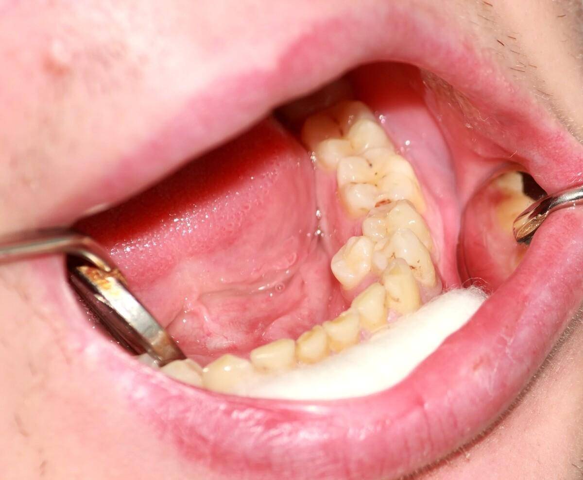 提醒:4种牙不拔反而危害健康