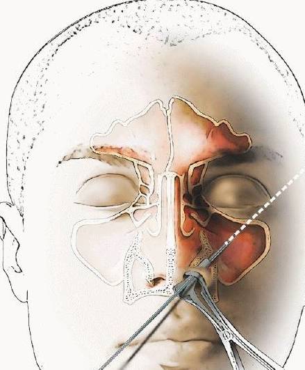 上頜竇炎遷延不愈,穿刺灌洗或可避免手術治療_病人_麻醉_鼻腔