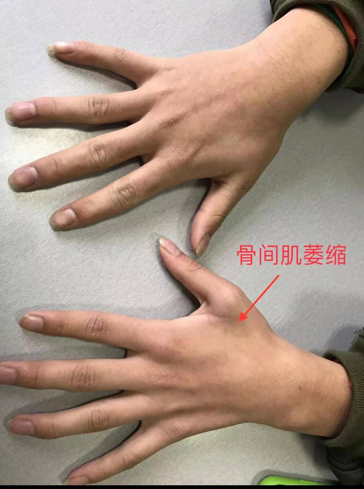 平山病-青少年上肢肌肉萎缩应注意