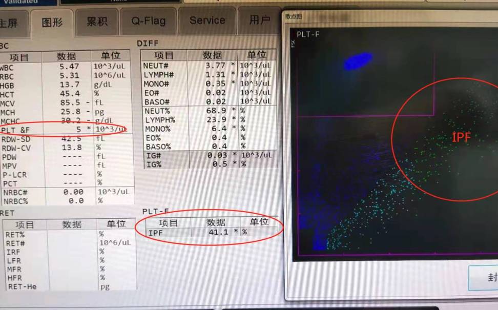 在fsc-sfl的散點圖上,對血小板進行計數,可有效地排除了電阻抗法(plt