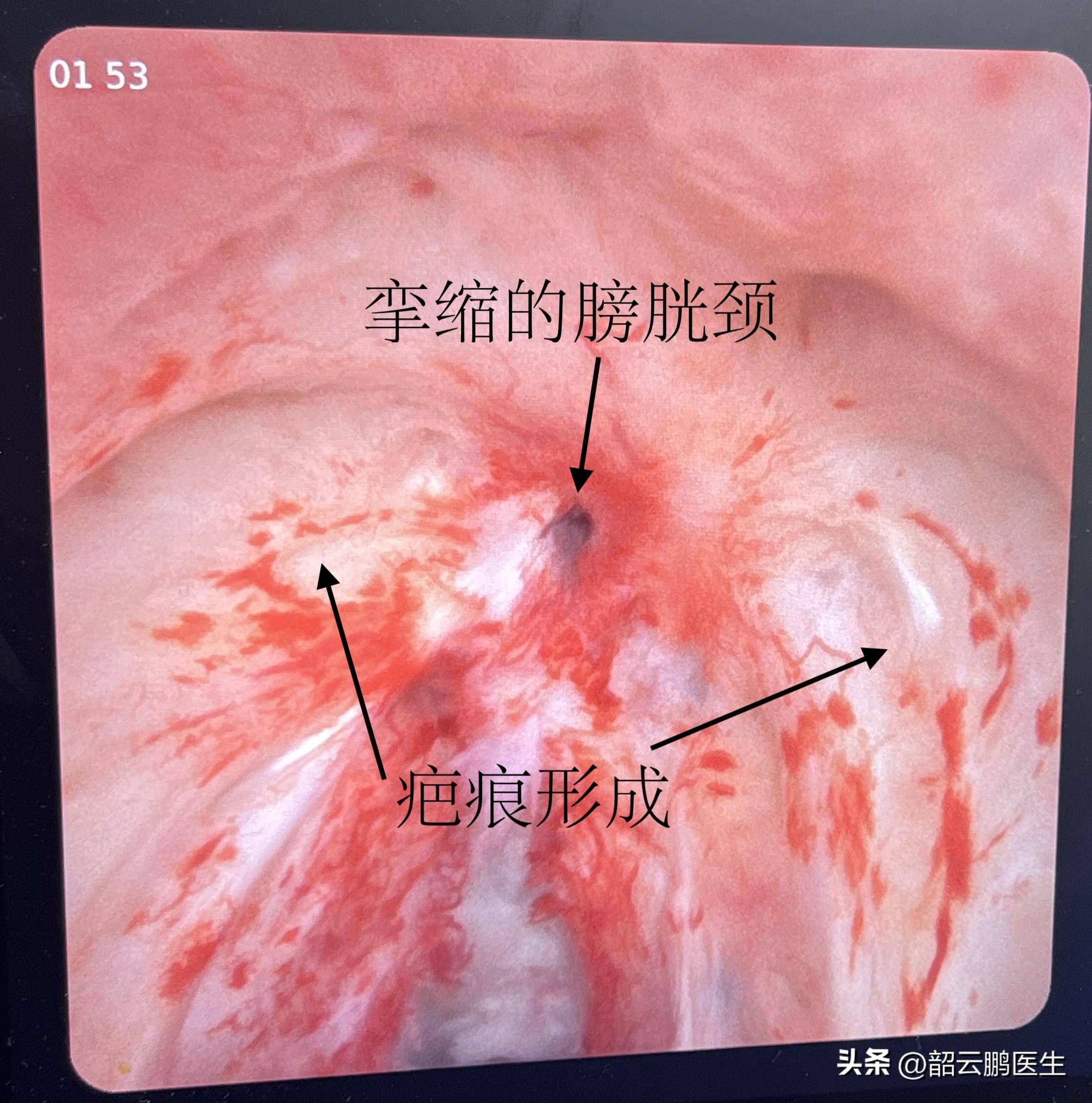 尿道瘢痕图片