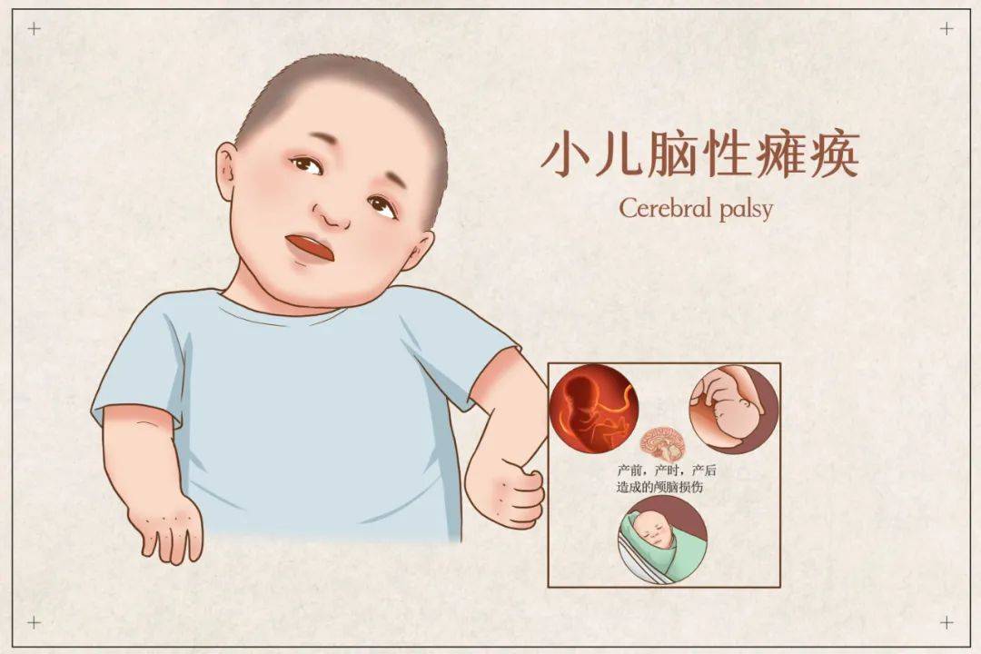 婴幼儿脑瘫的症状图片图片