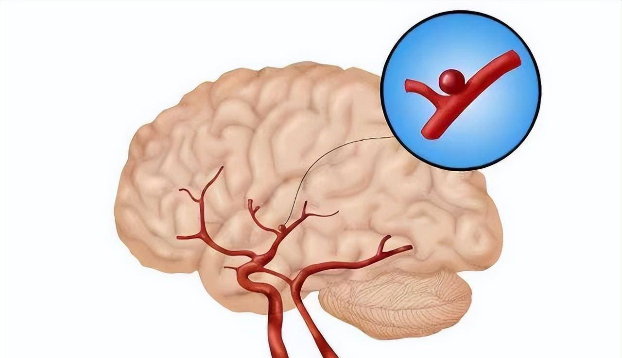 什么是腔隙性脑梗塞?脑梗的预防和治疗方法有哪些?