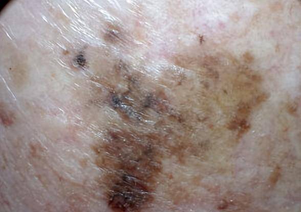 黑素细胞痣的边缘光滑,均匀,而黑色素瘤的边缘通常不规则,锯齿状,甚至