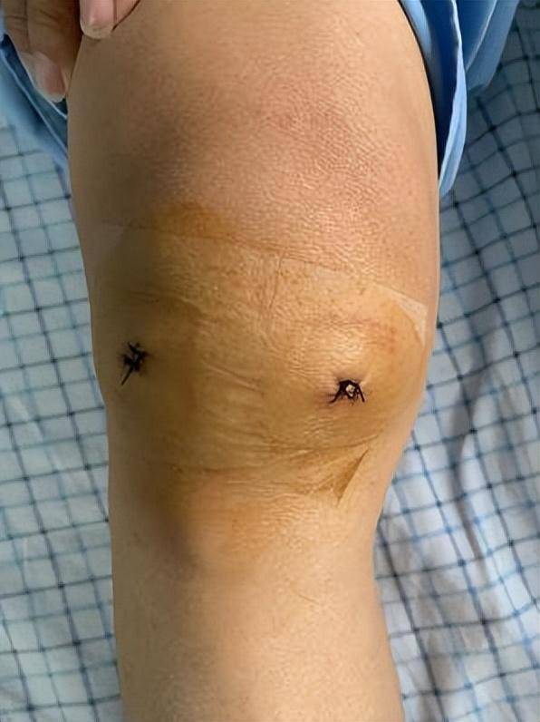 发哥"谈筋论骨"(五):关节镜下"捉鼠"记_软骨_老鼠_诊断