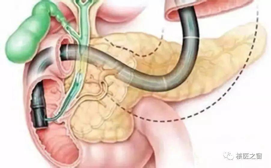 梗阻性黄疸不用慌,核医学显像来帮忙!_诊断_胆管_检查