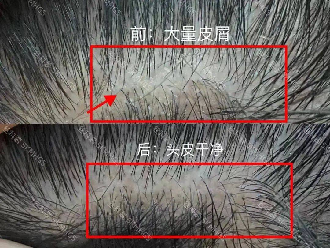 头皮微生态问题的尽头是脱发！_管理_头发_成分