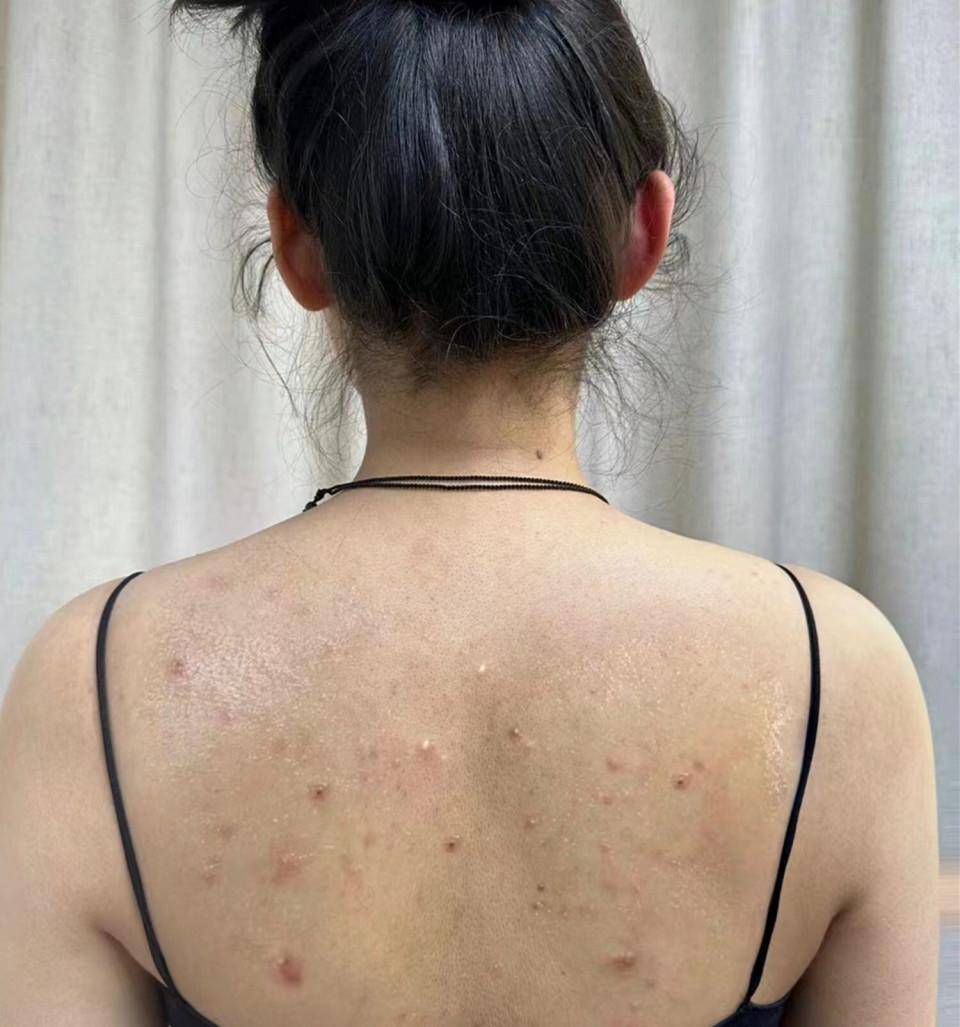 后背疙瘩粉刺反复瘙痒?跟着过来人学一招!痘痘粉刺一洗就掉!